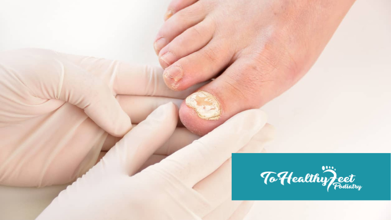 How Does A Foot Doctor Treat Toenail Fungus?